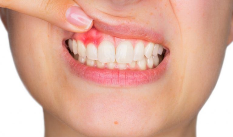 ontstoken tandvlees oftewel gingivitis